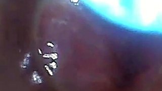 Endoscope POV: Test Tube Cock Urethral Insertion