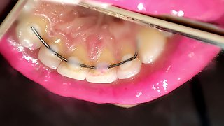 Permanent Retainers Mouth Tour